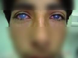 Corneal Opacity - Cancer Therapy Advisor