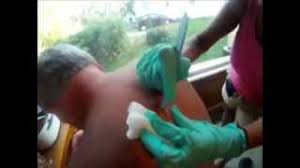 There are steps you can take to help it heal. Worlds Biggest Pimple World Record Warning Very Bad Youtube