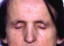 Image result for Systemic Sclerosis