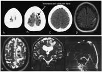Die magnetresonanztomographie (mrt) ist ein bildgebendes verfahren, das mittels starker magnetfelder und radiowellen detaillierte schnittbilder des körpers erzeugt. Abbildungen Und Graphiken Sinus Und Hirnvenenthrombose