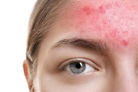 How to treat acne rosacea language:de. Learn How To Treat Acne Rosacea Key Differences To Acne