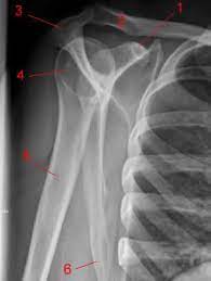 Lateral View Shoulder X Ray Shoulder X Ray Views X Ray Radiology Shoulder