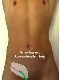 In diesem fall ist sie äußerlich nicht zu sehen, jedoch ist sie für den arzt tastbar. Leistenbruch Op In Nurnberg Klinik Hallerwiese De