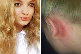 Patch testing is a way of identifying whether a substance that comes in contact with the skin is causing inflammation of the skin. Teen S Shocking Allergic Reaction To Hair Dye Patch Test Which She Says Saved Her Life