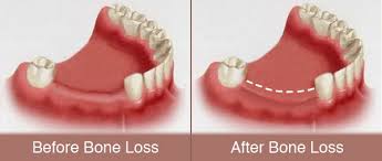 Periodontal Bone Regeneration In Mission Viejo Orange County Periodontists