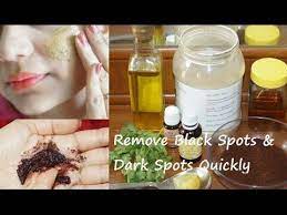 One of the natural remedies that helps to whiten dark spots and blemishes on the skin are potatoes. How To Remove Black Spots From Face Fast Naturally Due To Pimples Acne Hyper Pigmentation Home Rem Dark Spots On Skin Remove Dark Spots Dark Spots On Face