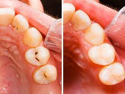 Dental implants are similar to your own teeth and will need the same care. Affordable Quality Dental Implants Dental World Manila