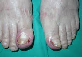 Image result for flegmona pedis)