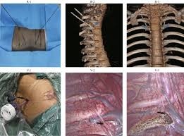 Image result for Radiofrequency Surgery