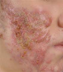 Isotretinoin is a very effective drug for treating severe recalcitrant nodular acne. Disorders Of Sebaceous And Apocrine Glands Fitzpatrick S Color Atlas And Synopsis Of Clinical Dermatology Seventh Edition