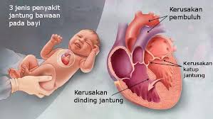 Koleksi oleh landa • terakhir diperbarui 3 minggu lalu. Penyakit Jantung Bawaan Ciri Gejala Penyebab Cara Mengobatinya