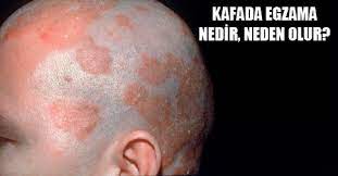 Kafada Egzama Neden Olur