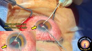 Image result for Hyphema