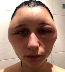 Hi, i trained in hairdressing many years ago but had to give it up due to being allergic to hydrogen peroxide. I Had A Lightbulb Head Woman S Face Balloons After Reaction To Hair Dye