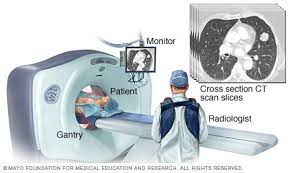 Lung Cancer Screening - Mayo Clinic