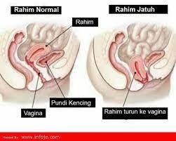 Rahim jatuh luisa turnip atasi dengan pose yoga ini. Wanita Wajib Baca Ni 9 Tanda Rahim Tak Sihat Jangan Biar Sampai Peranakan Jatuh Infoje Org