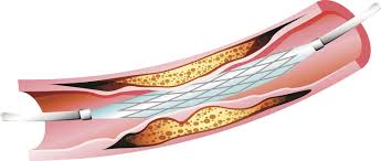 Can you stop a heart attack. When Do You Need A Heart Stent Harvard Health