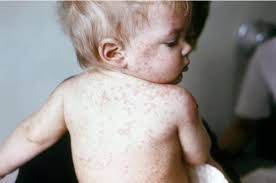 Image result for Measles