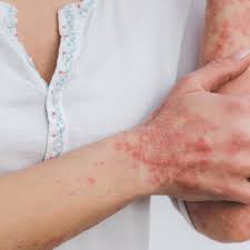 Image result for psoriasis