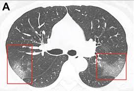 The official twitter page of national oilwell varco. Ct Imaging Of The 2019 Novel Coronavirus 2019 Ncov Pneumonia Imaging Technology News