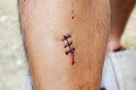 Avoid using the towel directly on the stitches. How Do You Know If You Need Stitches
