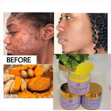 turmeric koljic acid cleansing pads Bye Dark marks acne hyperpigmentation