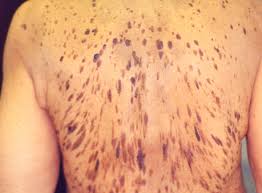 Scraping the skin's surface (curettage). Seborrheic Keratosis Removal Duct Tape