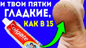 как избавиться от трещин на пятках с помощью глицерина Pyatki Gladkie Kak V 15 Dobav V Zubnuyu Pastu Obychnogo Treshiny Na Pyatkah Ischeznut Youtube