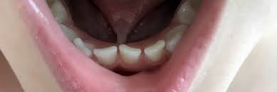 Image result for Ankyloglossia