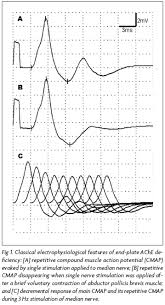 Electrophysiological Study In Synaptic Congenital Myasthenic Syndrome End Plate Acetylcholinesterase Deficiency