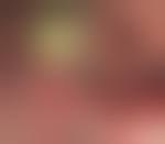 Image result for Colonoscopy in GI Bleeding