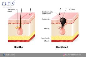 Image result for Sebaceous Gland