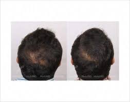 Hair Thinning At Crown Of Male Patient Before After Results Malepatternbaldness Male Pattern Baldness Hair Thinning At Crown Pattern Baldness