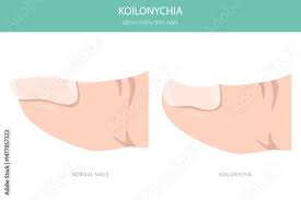 Image result for Koilonychia feet