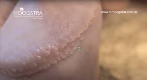Pearly Penile Papules - Tyson's Glands - Hoogstra Buenos Aires