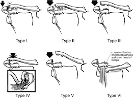 Image result for AC Dislocation