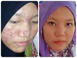 Jerawat boleh muncul pada bahagian badan atau muka bayi. Ubat Jerawat Di Badan Rawatan Z