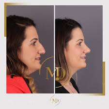 Burun Estetigi Rinoplasti Rhinoplasty Rinoplasti Bursa Sevgililer