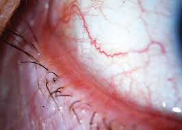 Image result for lesion sclera