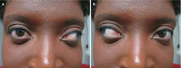 Exotropia Ento Key
