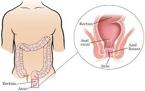 Persistent cramps or low back pain, cramping pain in the lower stomach. About Anal Fissures Memorial Sloan Kettering Cancer Center