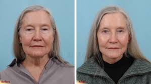 Facelift Photo Gallery