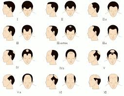If you have decided to begin the battle against your hair loss, and are looking for effective treatments for your receding hairline, you are not alone. How To Deal With A Receding Hairline The Right Way