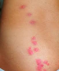 Image result for bedbug bites look like