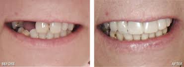 It is always possible to turn a truly bad situation that you may have lived with for years into one that allows you to exude confidence while laughing, eating, speaking, and enjoying social situations. Happy Dental Geelong West Gentle Caring Andd Quality Dentistry