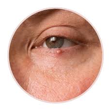 Image result for milium cyst on eyelid
