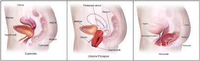 Find the perfect female private parts stock photos and editorial news pictures from getty images. There S Something Falling Out Of My Vagina Integral Physical Therapy
