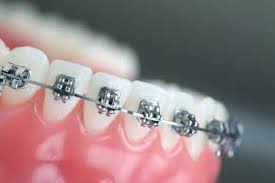 After removing the cotton after one hour fill up your mouth with chilled water no moving it around just keep it in and swallow it slowly. Do I Need To Have My Wisdom Teeth Removed Before Starting Orthodontic Treatment