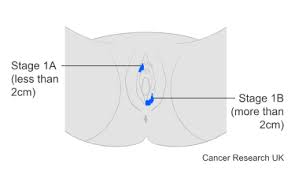 Image result for Vulvar Cancer