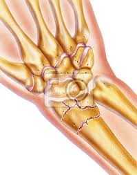 Der auf der daumenseite verlaufende knochen (radius) wird dabei häufiger gebrochen als die elle (ulna). Hand Und Gebrochenes Handgelenk Gebrochener Radius Knochen Leinwandbilder Bilder Elle Karpaltunnelsyndrom Radius Myloview De